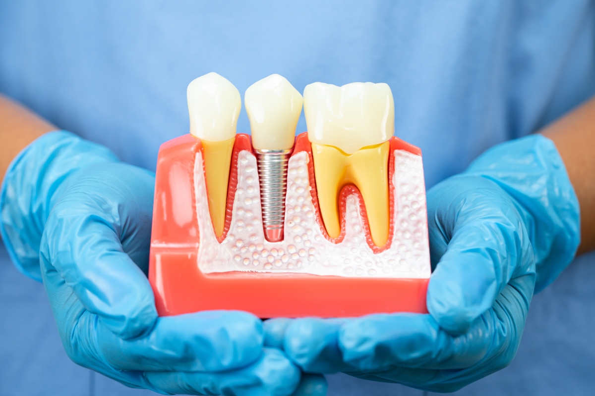 Dental Implants Fort Worth